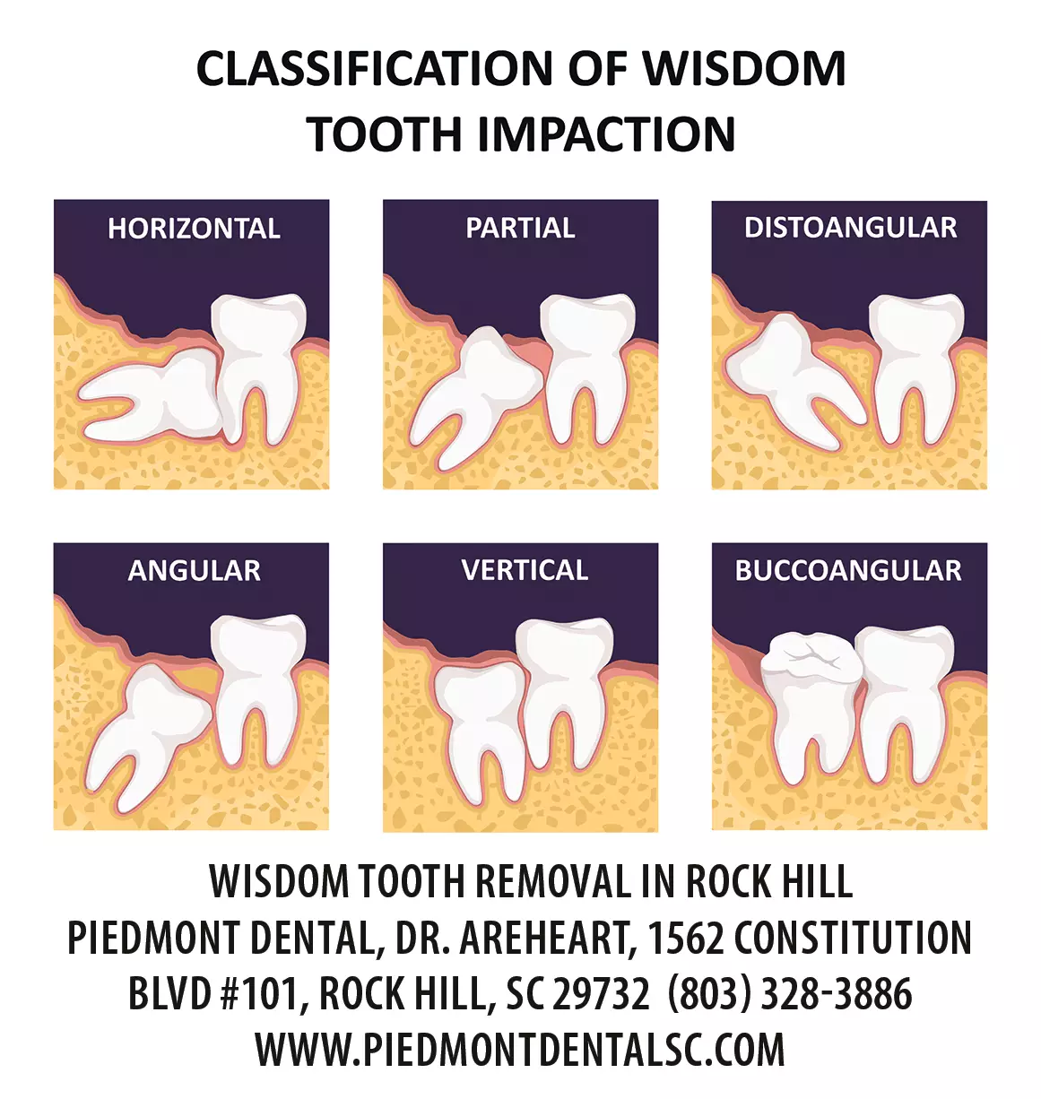 illustration of wisdom tooth removal