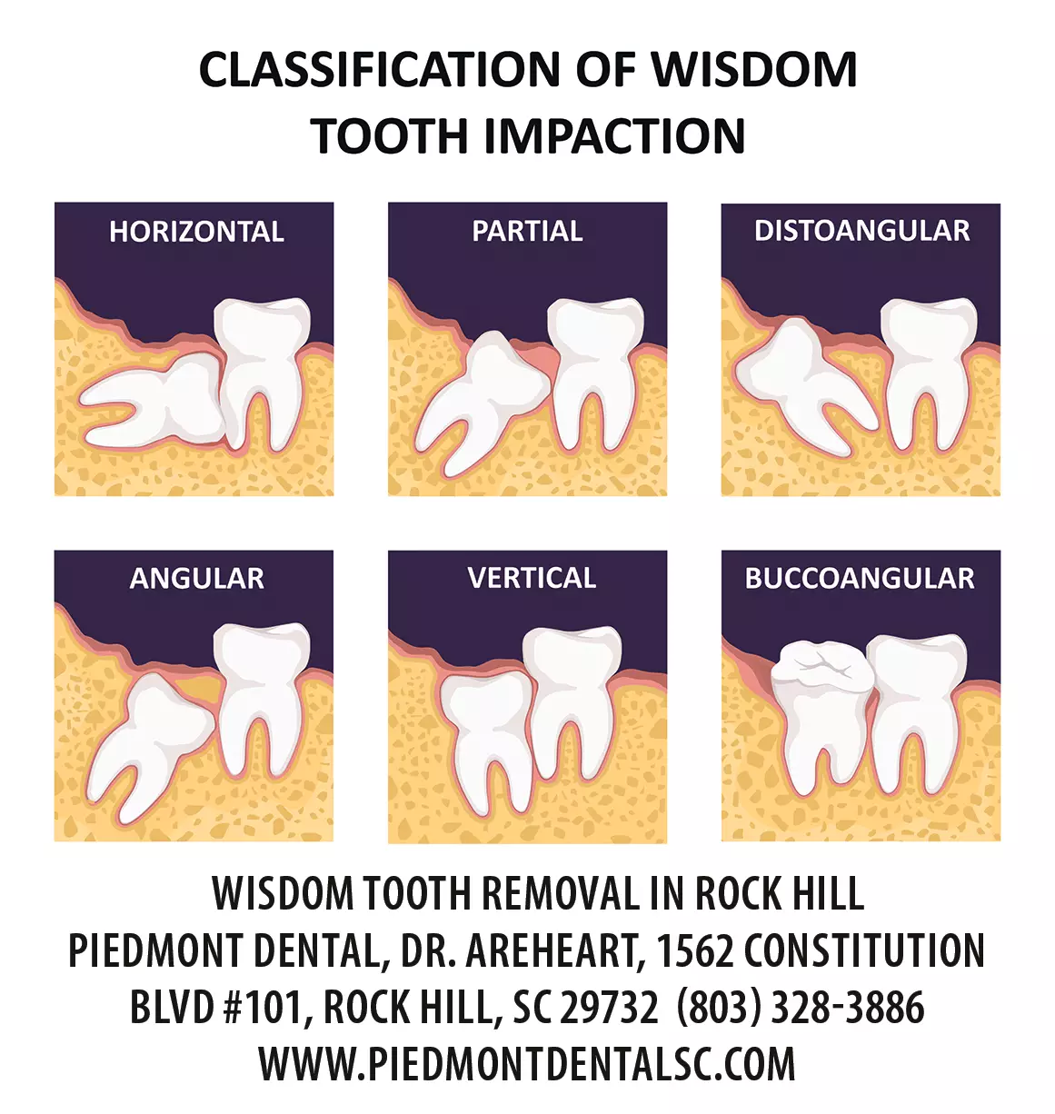 Wisdom Teeth Extraction In Rock Hill SC Oral Surgeon For Wisdom Tooth Removal Piedmont