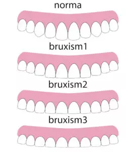 infograph educating about bruxism