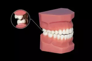 example of teeth gnashing and causing damage to the mouth