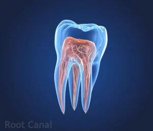 graphic of infect tooth that needs root canal treatment