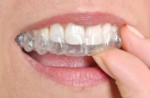 woman removing her clear braces