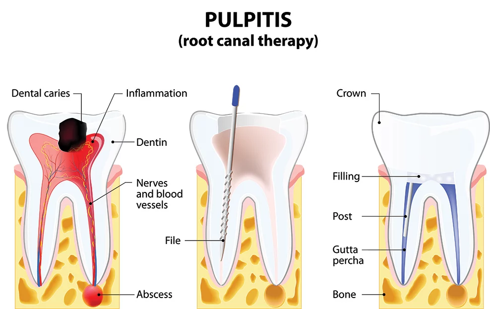 graphic showing how a root canal is performed