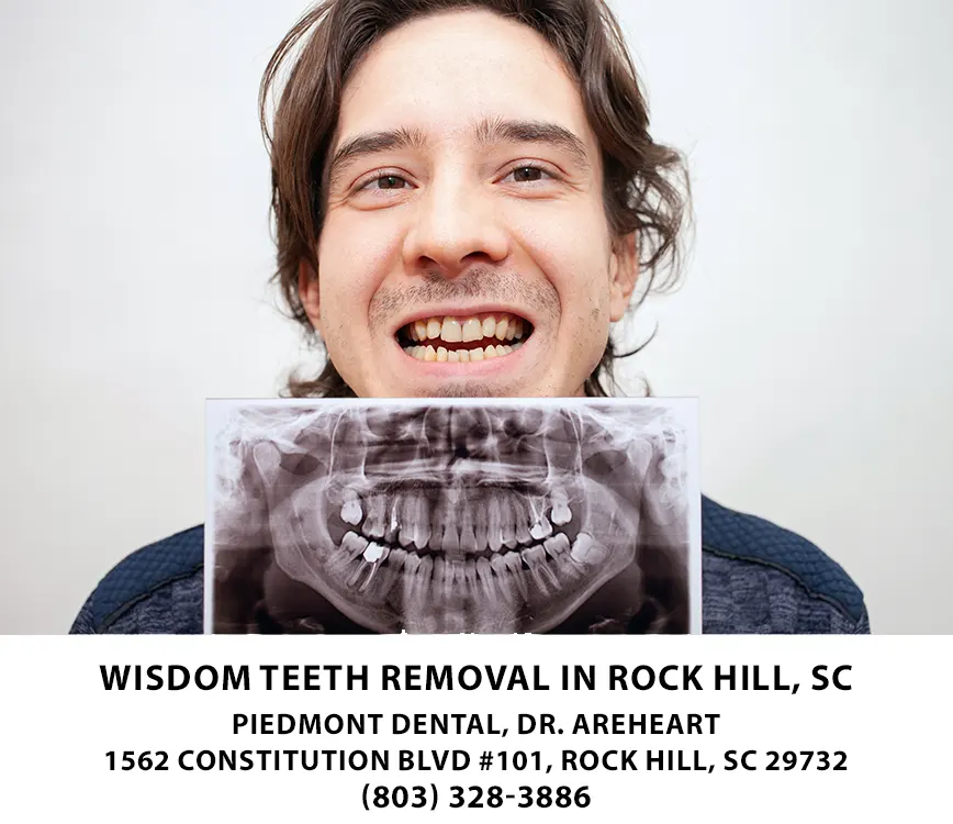Man holding xray of his teeth showing impacted wisdom teeth that need to be removed