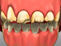 image illustration damaged teeth