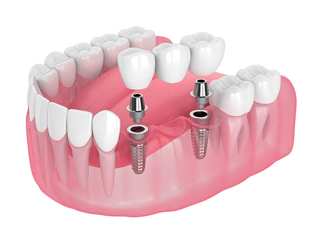 educational dental implant illustration
