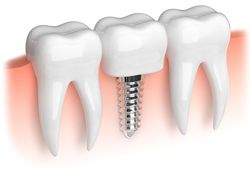 patient after receiving a dental implant at piedmont dental