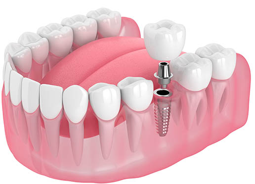 educational dental implant illustration