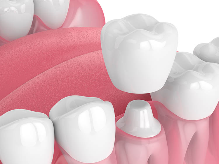 illustration of a dental crown