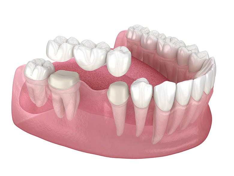 graphic of an implanted dental bridge