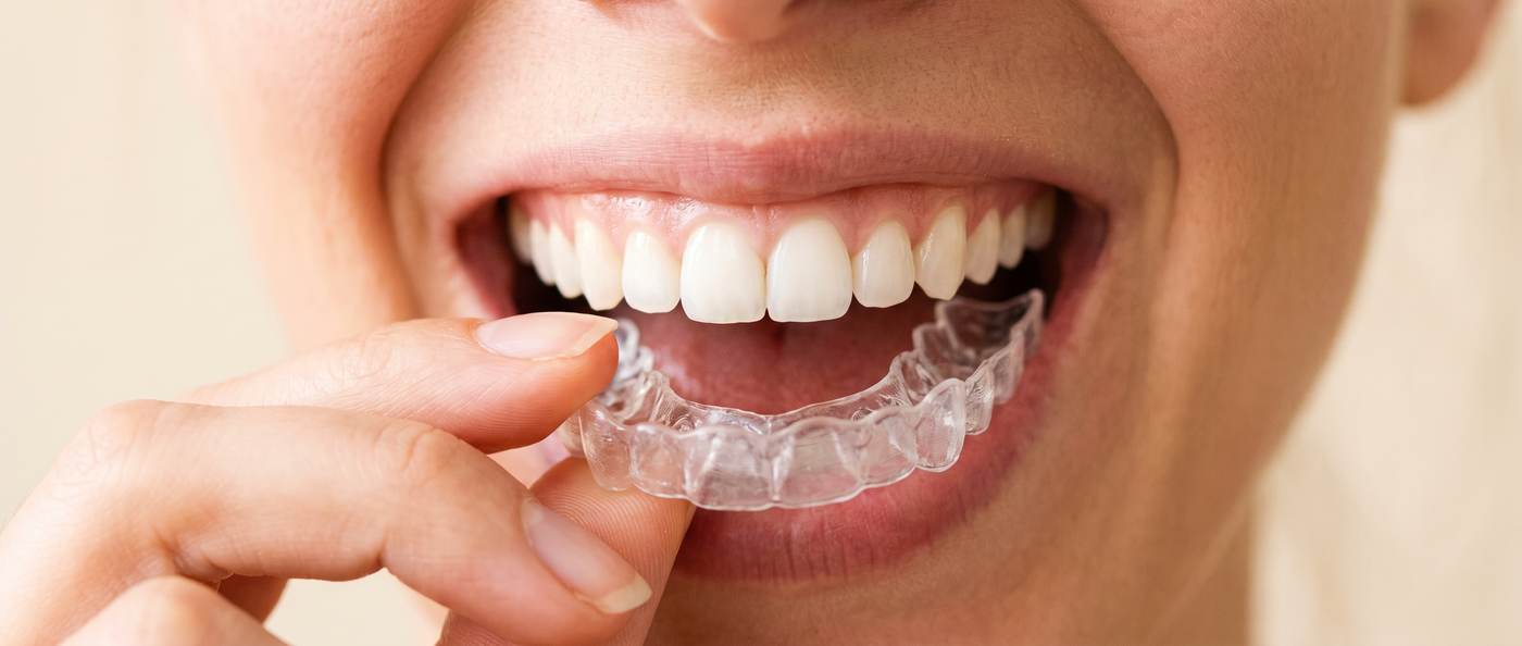 Bright smile with a professional whitening tray