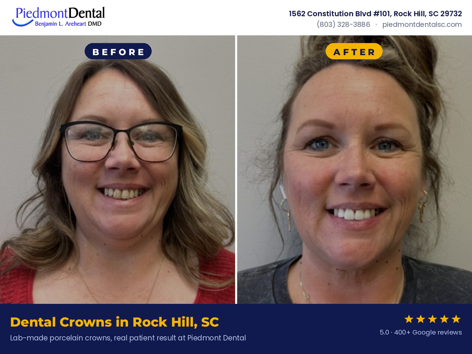 Before and after porcelain crowns on upper front teeth, a real patient treated by Dr. Areheart at Piedmont Dental in Rock Hill, SC