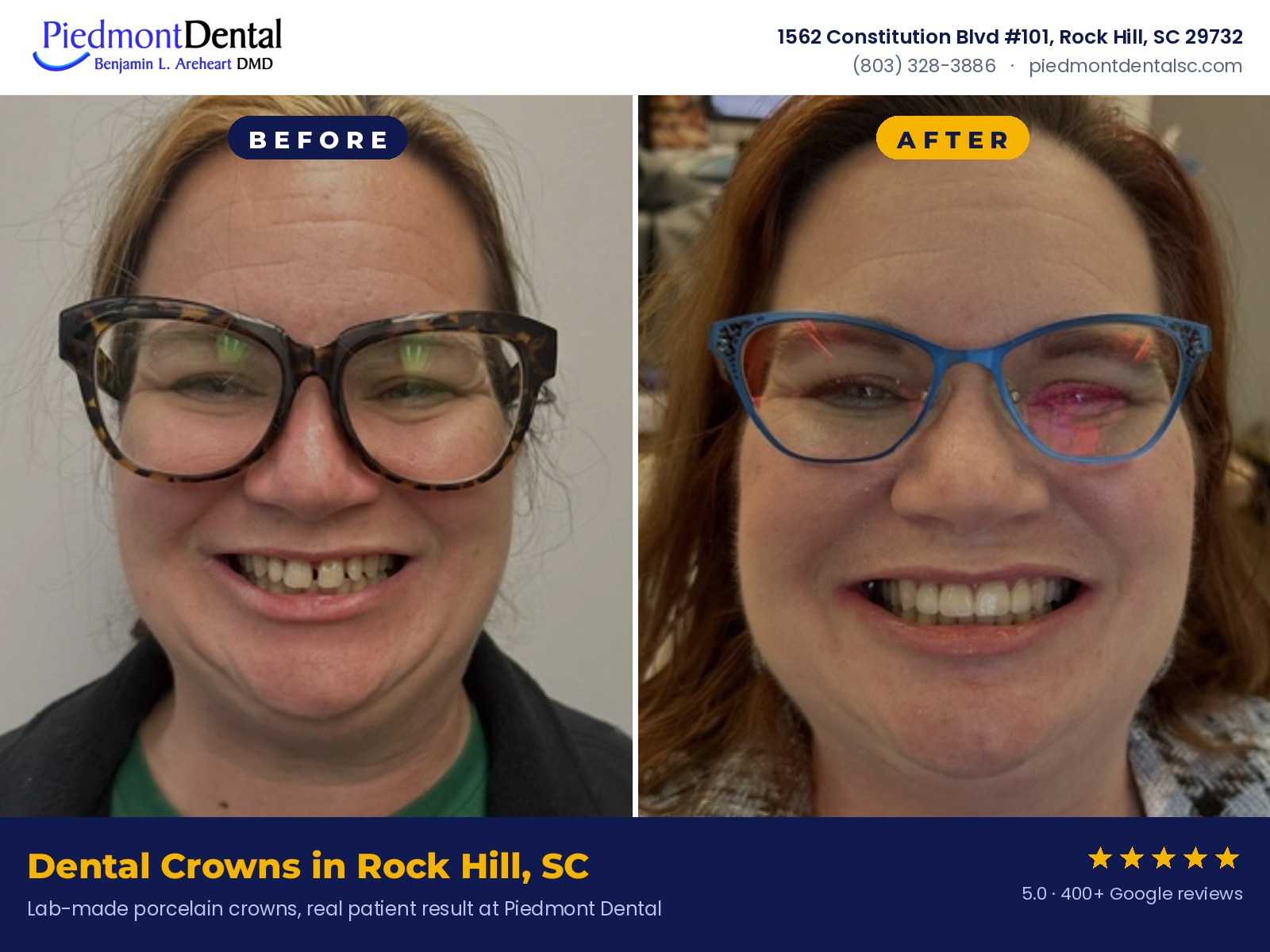 Before and after dental crowns, real patient result at Piedmont Dental in Rock Hill, SC
