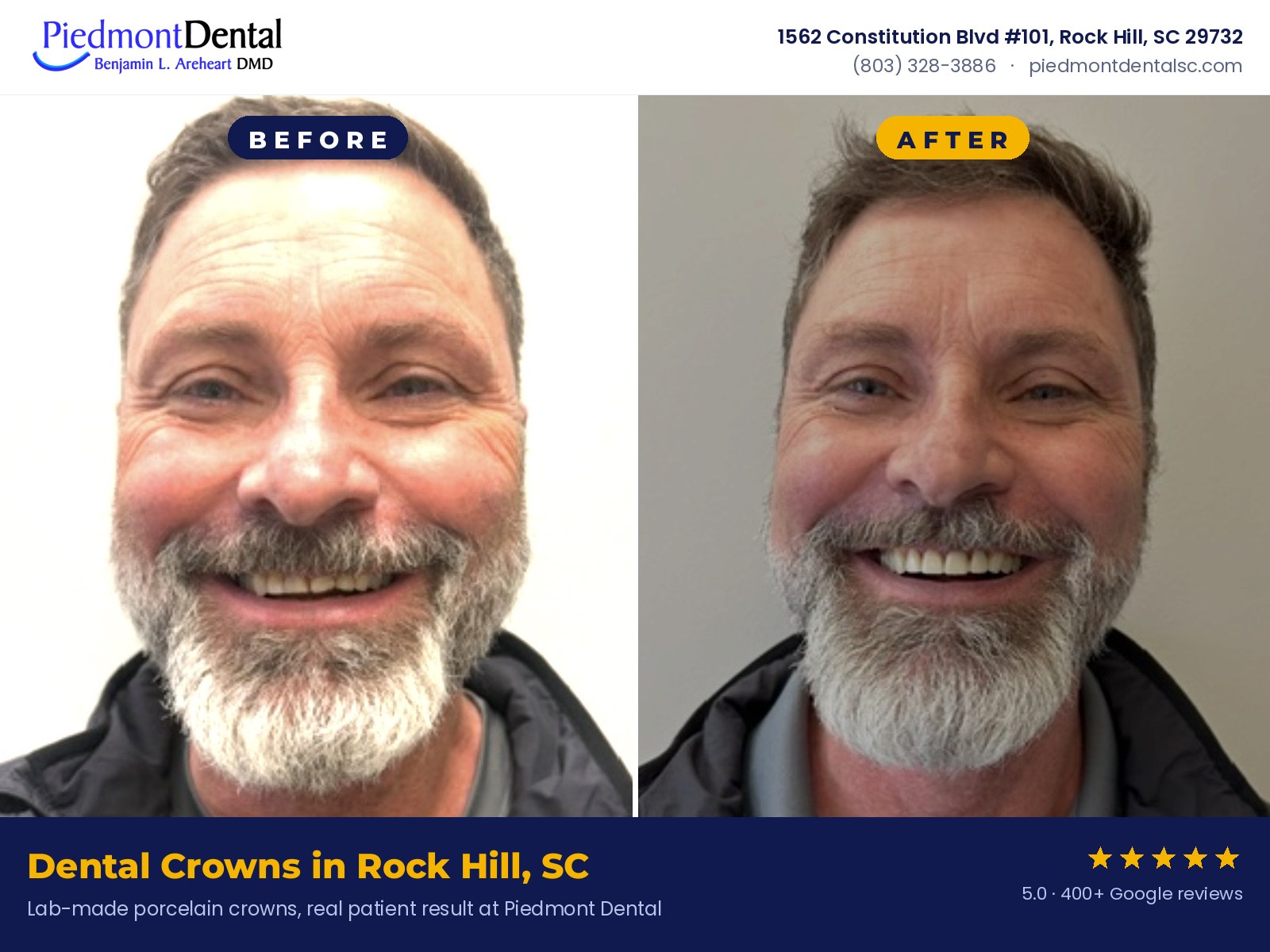 Dental crown before and after, real patient treated at Piedmont Dental, Rock Hill, SC