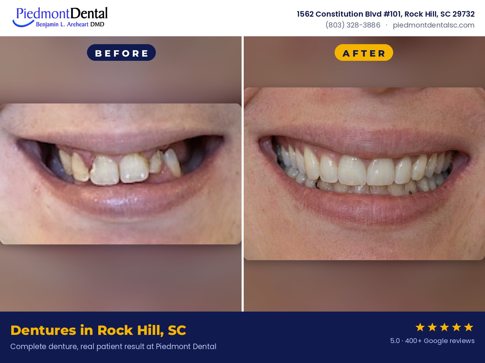 Before and after a complete denture, real patient result at Piedmont Dental in Rock Hill, SC